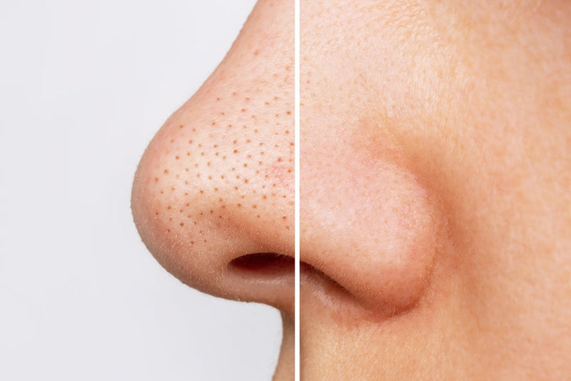 Blackheads
