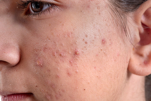 Acne & Breakouts