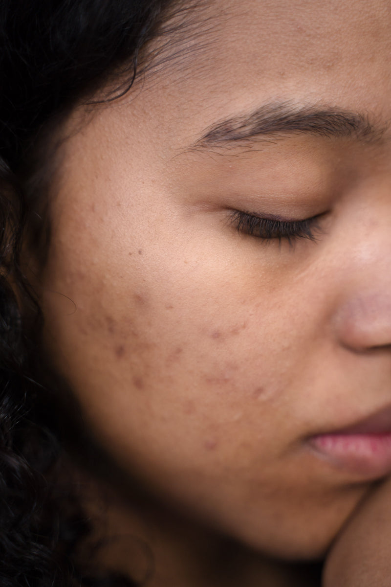 Hyperpigmentation