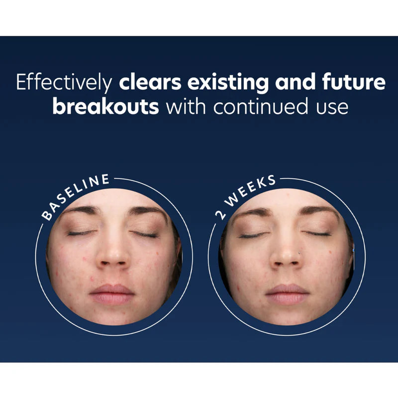 Before and after comparison of skin with acne treatment showing effectiveness.