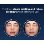 Before and after comparison of skin with acne treatment showing effectiveness.