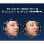 Before and after comparison of a person's face with text indicating improvement in breakout appearance.
