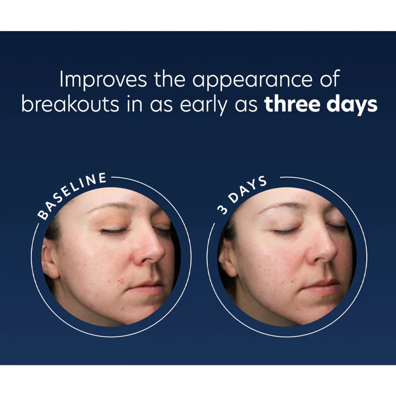 Before and after comparison of a person's face with text indicating improvement in breakout appearance.