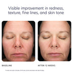 Visible improvement in redness, texture, fine lines, and skin tone