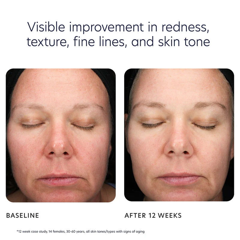 Visible improvement in redness, texture, fine lines, and skin tone